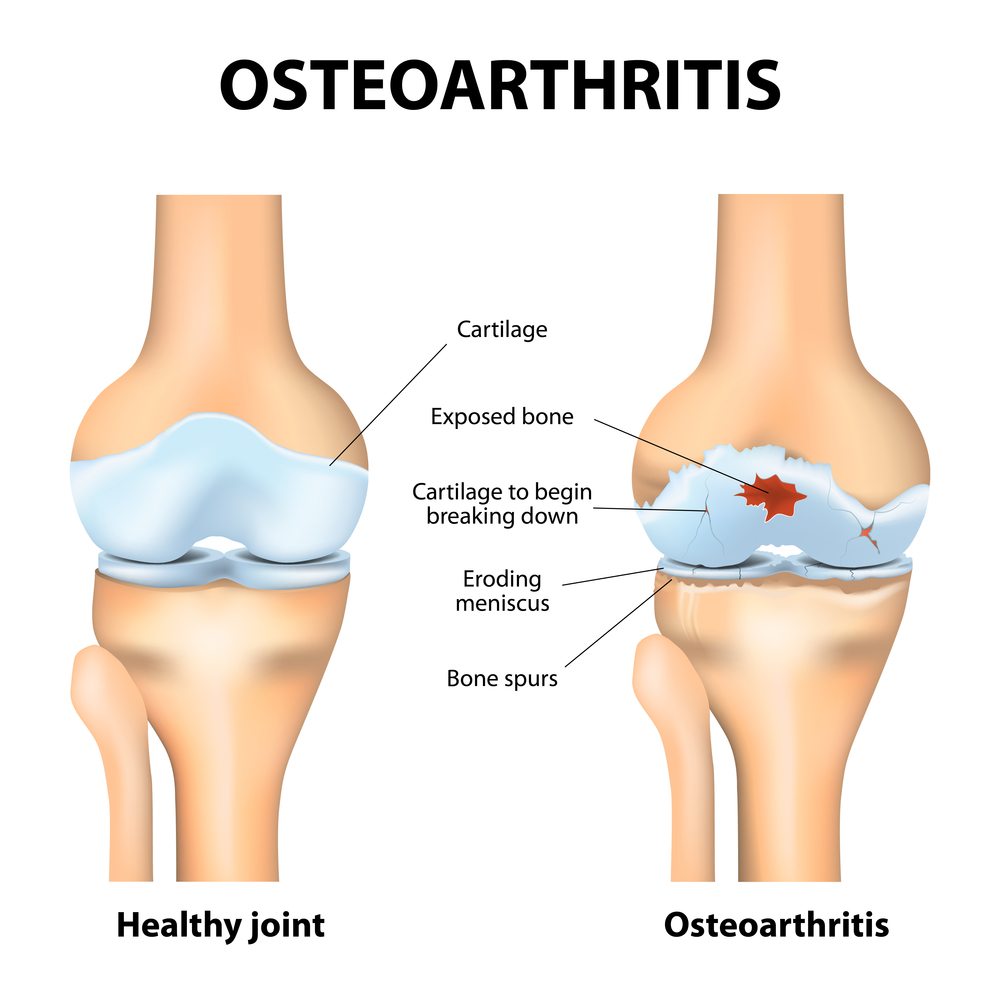 Osteoarthritis Knee Exercises Avoid