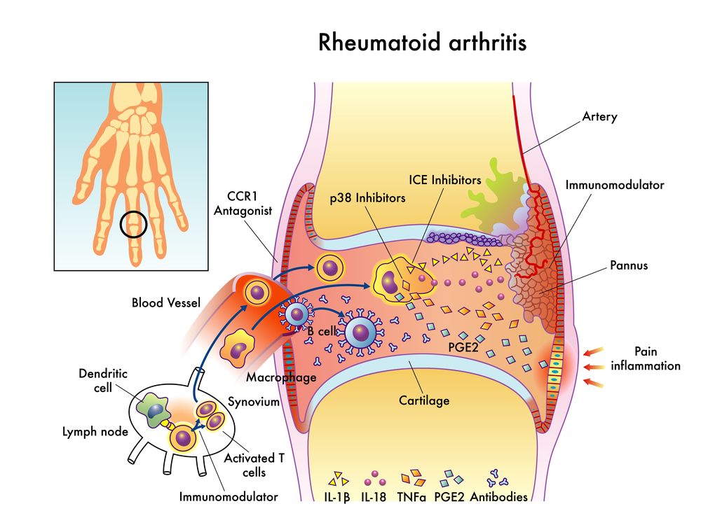 what to take for rheumatoid arthritis